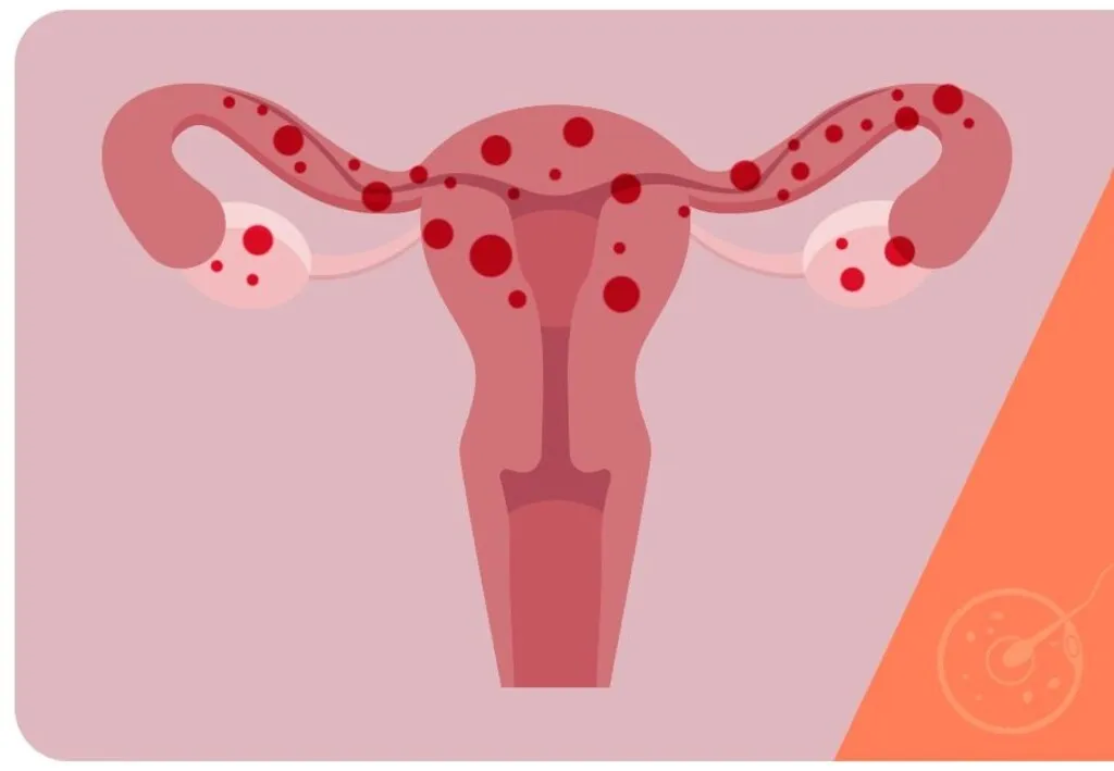 Endometriose, entenda o que é, e os tipos de tratamento para cada mulher